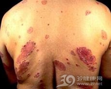线状IgA大疱性皮肤病