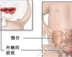 泄殖腔外翻