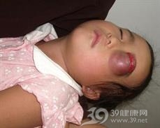 眼部肿瘤