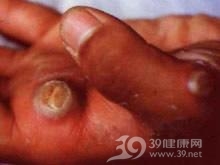 羊痘