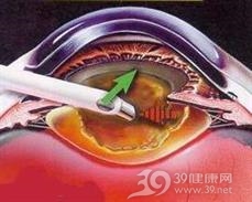 阴道粒细胞肉瘤