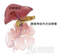 胰多肽瘤