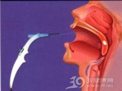婴儿猝死综合征