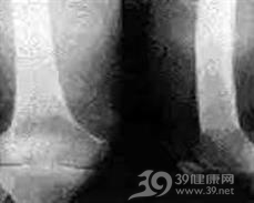 原发性骨淋巴瘤