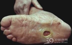 原发性皮肤结核综合征