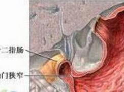 原发性十二指肠恶性淋巴瘤