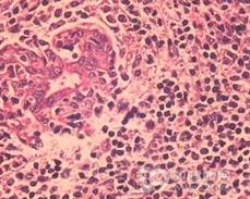 原发性腮腺淋巴瘤