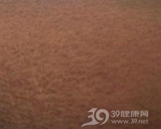 原发性限局性皮肤淀粉样变