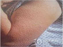 原发性系统性淀粉样变