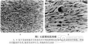 原发性心脏横纹肌肉瘤