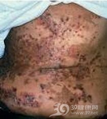 胰高糖素瘤综合征