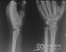 月骨脱位及月骨周围脱位