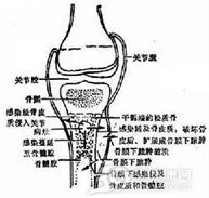 硬化性骨髓炎