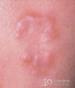 硬化性脂肪肉芽肿