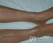 硬化症