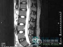亚急性坏死性脊髓炎