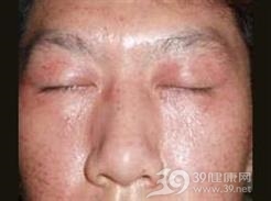 颜面复发性皮炎