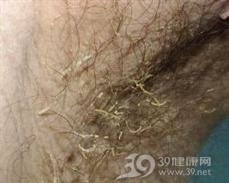 腋毛癣菌病
