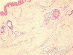 幼年性透明纤维瘤病