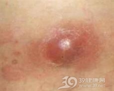 痈