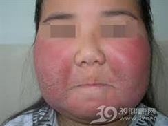 油漆皮炎