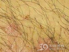 阴虱病