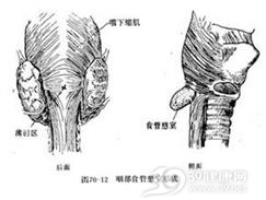 咽食管憩室