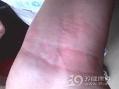 药物过敏