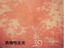 药物性皮炎