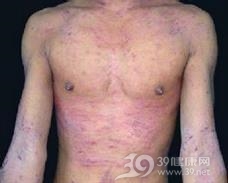 特应性皮炎