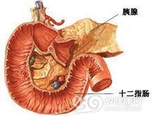 胰腺多肽瘤