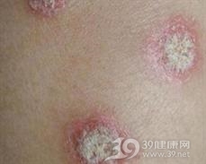 圆形糠疹