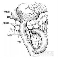 胰腺囊肿