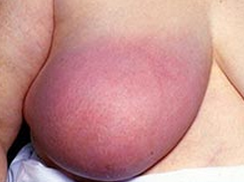 炎性乳癌