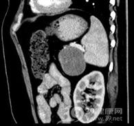 胰腺肉瘤