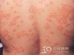 痒性紫癜