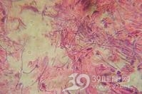 厌氧菌感染