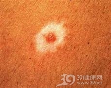 晕痣
