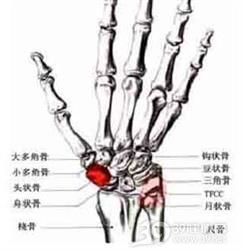 月状骨骨软骨病