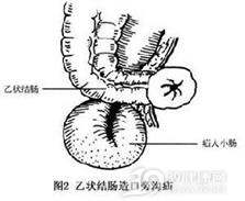 乙状结肠造口旁沟疝