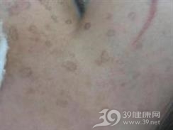 疣状角化不良病