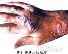 疣状皮肤结核