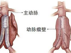炎症性腹主动脉瘤