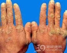 疣状肢端角化病