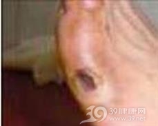 足穿通性损害