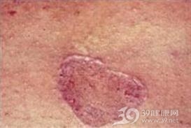 紫癜性扁平苔藓