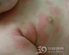 中毒性红斑
