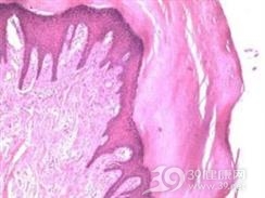 肢端纤维角化瘤