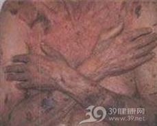 中毒性紫癜