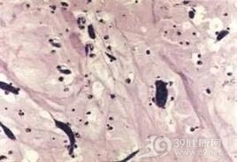 左房恶性黏液瘤
